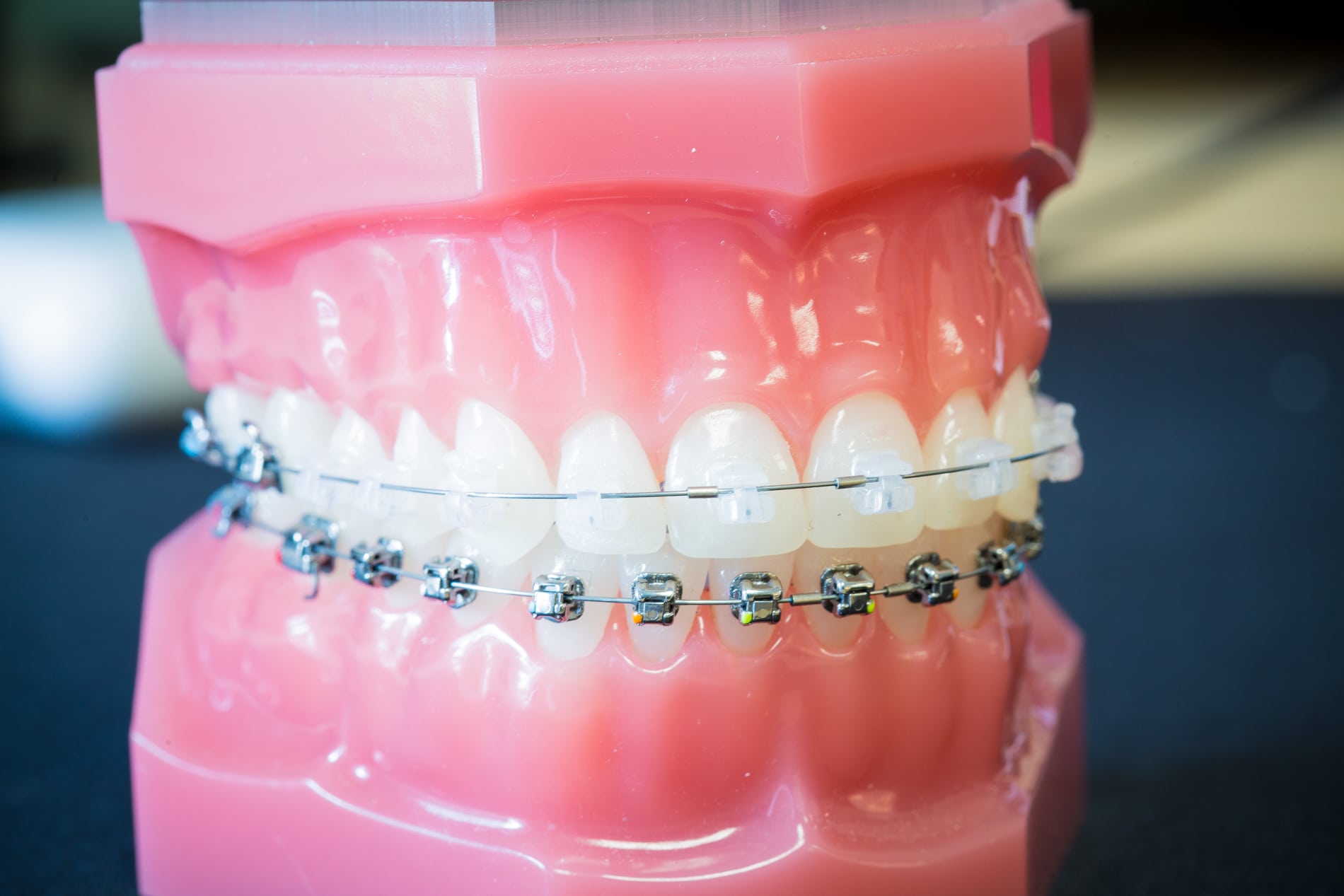 clear bracket braces with colored bands